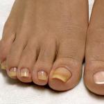 Онихомикоз или грибок ногтя в запущенной стадии