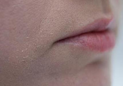 Почему появляется раздражение вокруг рта